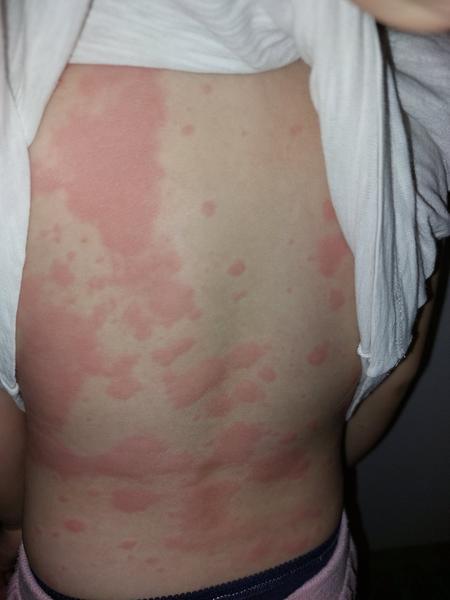 Co může způsobovat vyrážku u dcery? Mandarinky nebo nemoc?