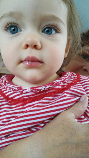 Povlak na rtu u 16měsíční dcery