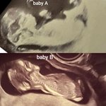 Lze odhadnout pohlaví podle ultrazvuku ve 12. týdnu?