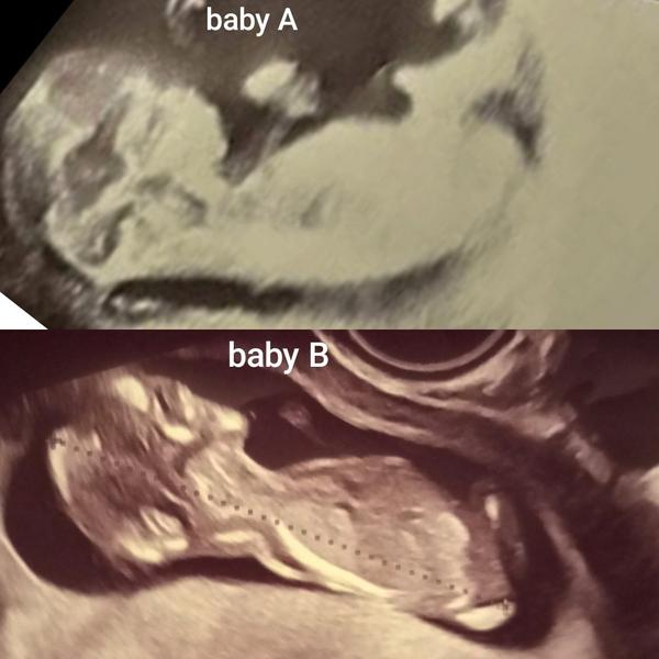 Pohlavie podla ultrazvuku