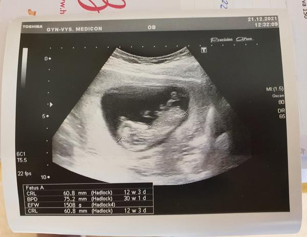 Jak poznat pohlaví? Diskutujeme možnosti.