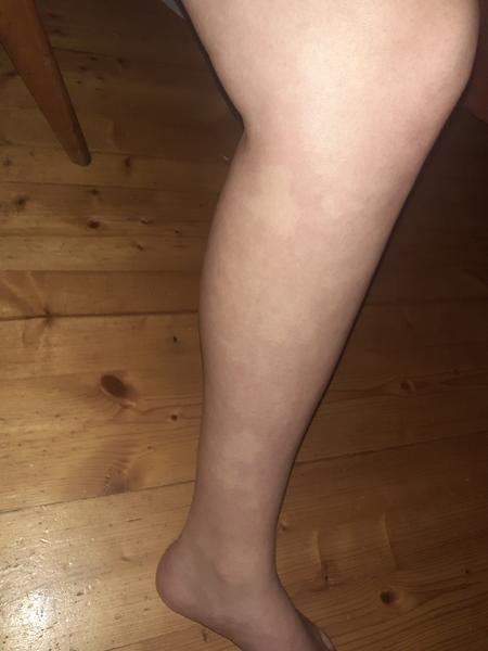 Bílé fleky na noze při stání. Co to znamená?