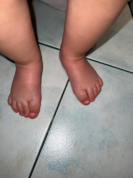 16měsíční dítě. Vbočený palec nebo deformace chodidla?