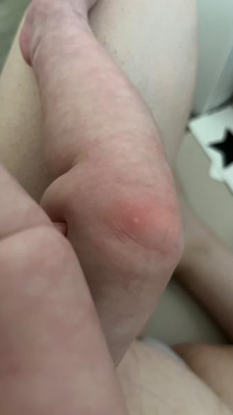 Červené fleky s bílým vnitřkem. Nemůže to mít souvislost s komplikacemi po porodu?