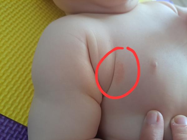 Suchá vyrážka u dítěte. Jaké jsou možné příčiny?