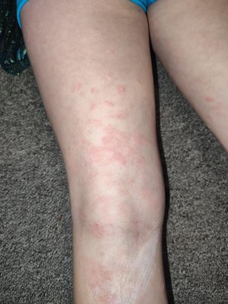 Ekzém nebo alergická reakce u dětí? Co způsobuje svědění?