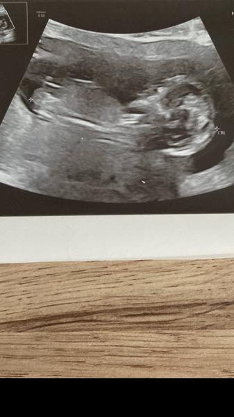 Jak poznat pohlaví z ultrazvuku ve 13. týdnu?