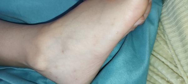 Záhadné pupínky u dcery. Může to být ekzém?