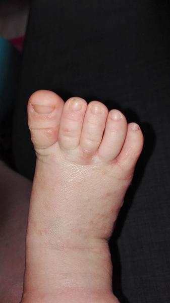 Alergie na mrkev u 11měsíční holčičky?