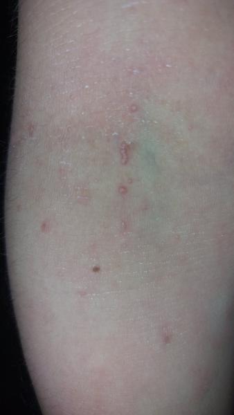 Pupínky u atopického ekzému. Mohou to být molusky?