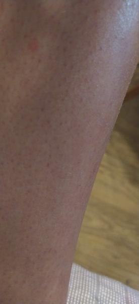 Je svědivý pupínek na noze příznakem něčeho vážného?