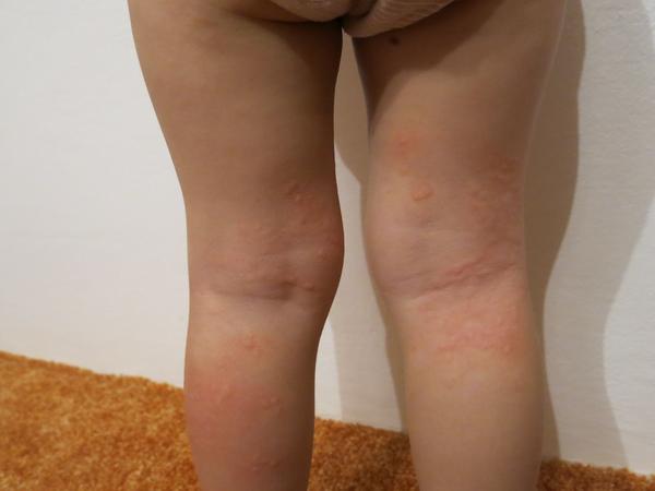 Výsev "puchýřků" u dvouletého dítěte, prosím o radu