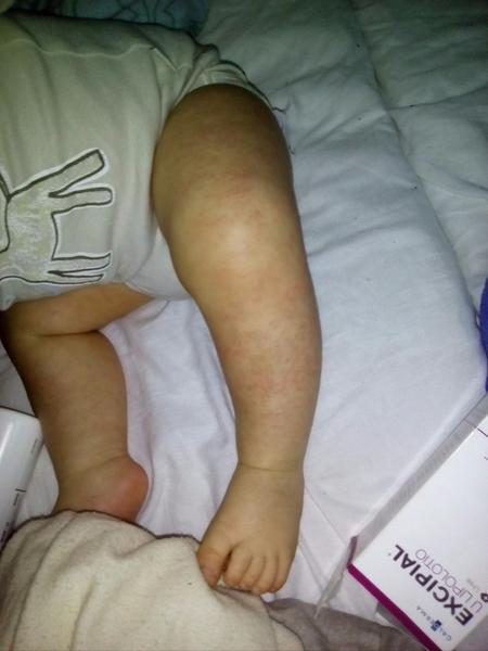 Co je to za vyrážku?