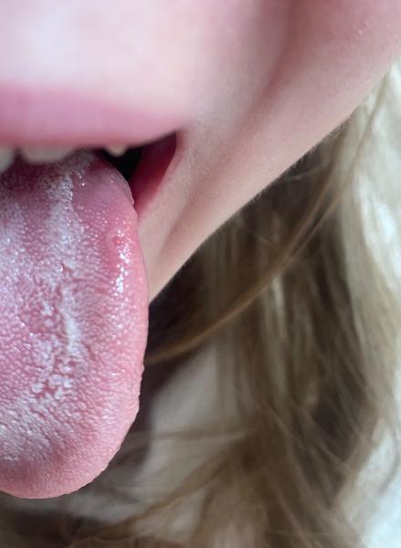 Je bezbolestný flek na jazyku běžný?