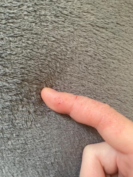 Může suchá kůže s puchýřky znamenat vyrážku?