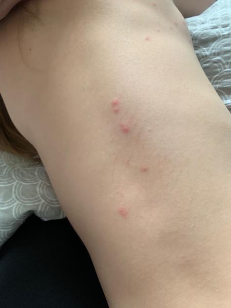 Jsou pupínky u dcery příznakem neštovic?