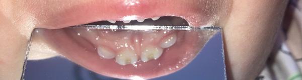 Ostré mléčné zuby u dvouleté dcery. Jak řešit?