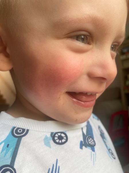 Máte zkušenosti s červenými uši, tvářemi a vyrážkou?