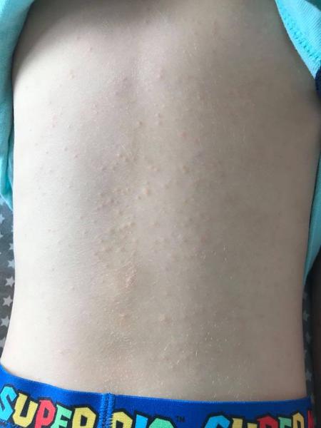 Vyrážka. Co by to mohlo být? 