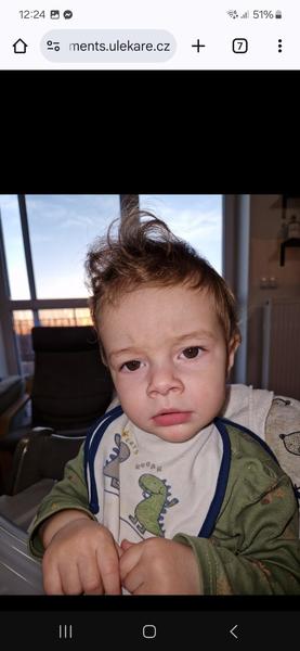 Výraznější cévičky a červený flíček na tváři: Co to je?