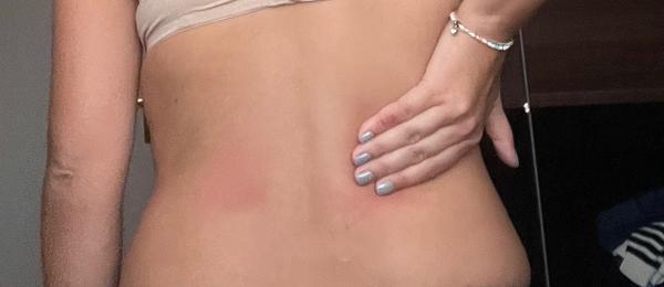 Je normální mít vystouplý sval na zádech?