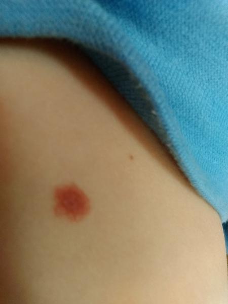 Piha. Mám urgovat kožní?