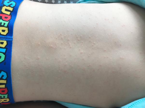 Vyrážka. Co by to mohlo být? 