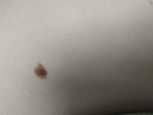 Znamínko. Máte někdo takové?