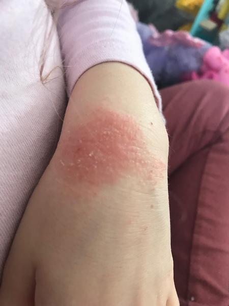 Ekzém, dcerka 3,5 roku. Je kvasinkový?