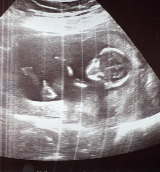 Holčička nebo chlapeček?