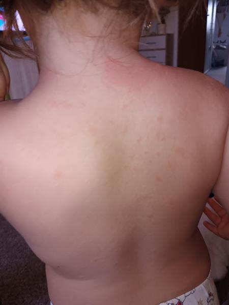 Ekzém již týden a dcera se stále drbe. O co by se prosím mohlo jednat a jak tomu pomoci, aby se to nešířilo?