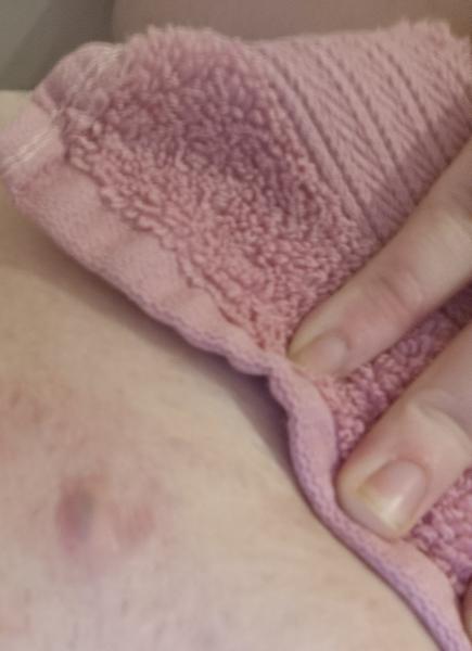 Co znamená bolestivá bulka v podbřišku?