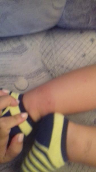 Malého něco poštípalo, čím to vyléčit?