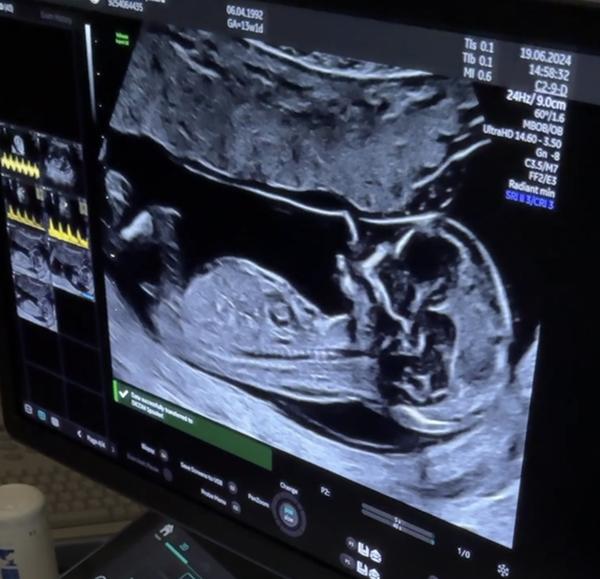 Pohlaví miminka. Jaké je?