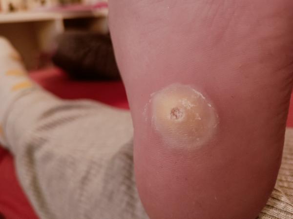 Má moje dcera bradavici nebo kuří oko na noze?