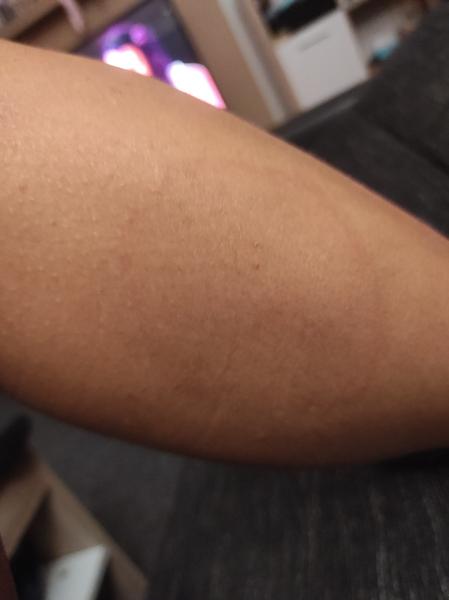 Jsou kruhy na kůži po klíštěti příznakem boreliózy?