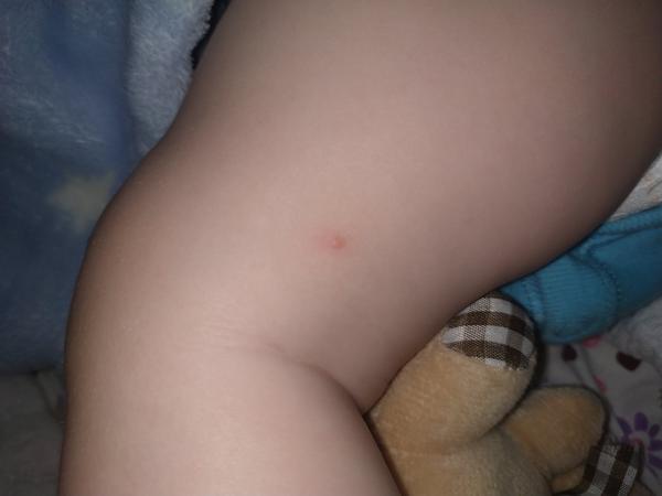 Myslíte, že se může jednat o neštovice?