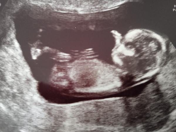 Screening ve 13. tt - foto. Našel by někdo pohlavní hrbolek?