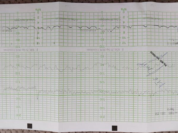 KTG děložní činnost. Zkušenosti?