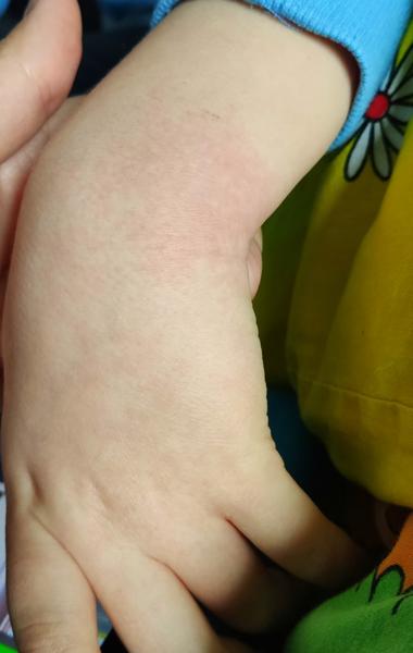 Co způsobuje vyrážku po podání léků jako Panadol a Nurofen?