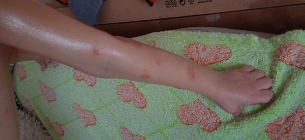 Ekzém nebo kvasinka?