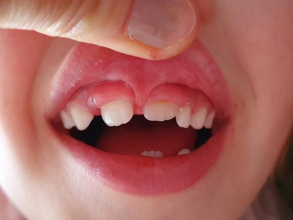 Jak řešit uzdičku mezi zuby u dětí v Mladé Boleslavi?