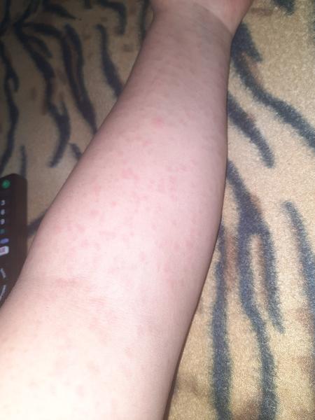 Neštovice nebo alergie: Jak rozlišit vyrážku na kůži?