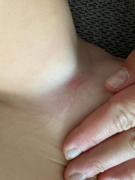 Jak léčit štípance od sametky či svilušky u dětí?