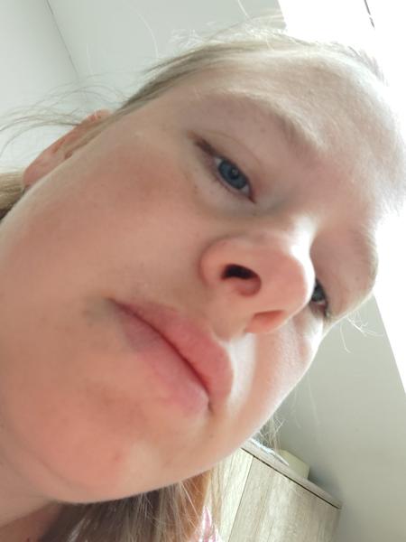 Fialové rty v těhotenství. Je nutné vyhledat lékaře?