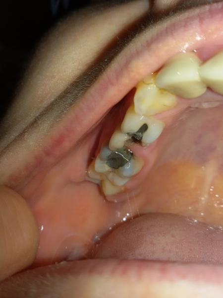 Ulomený zub a opuchlá tvář. Dren pomohl, ale k zubaři jdu až za 3 měsíce. Není to pozdě?