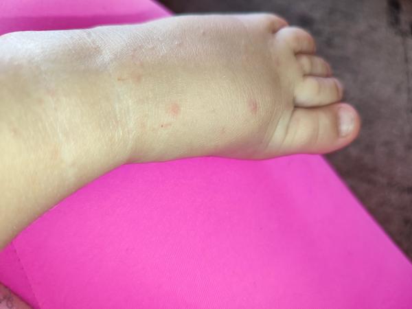 Vyrážka. O co by se mohlo jednat?