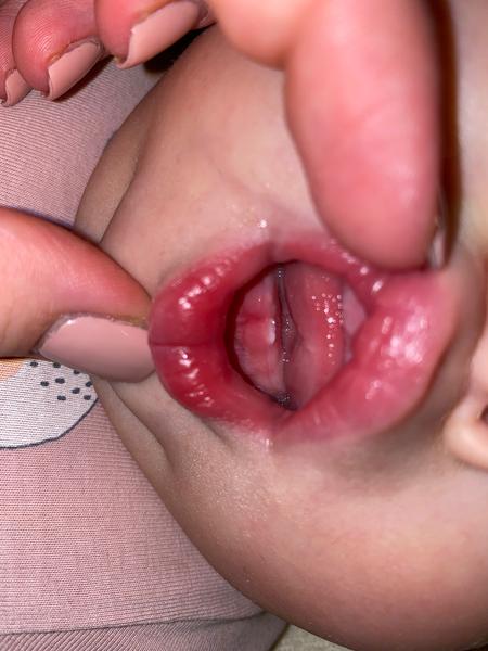 Horečky u miminka. Mohou souviset s prořezáváním zubů?