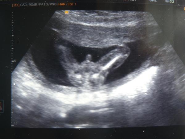 Taky na ultrazvuku vidíte klučinu?