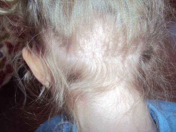 4-leté dceři padají vlasy - co na to?